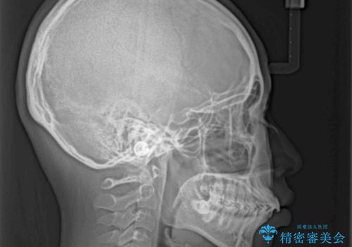 飛び出した上顎前歯 抜歯矯正でスッキリとした横顔にの治療前