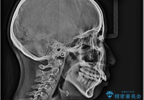 【インビザライン】抜歯矯正で口元も改善の治療前