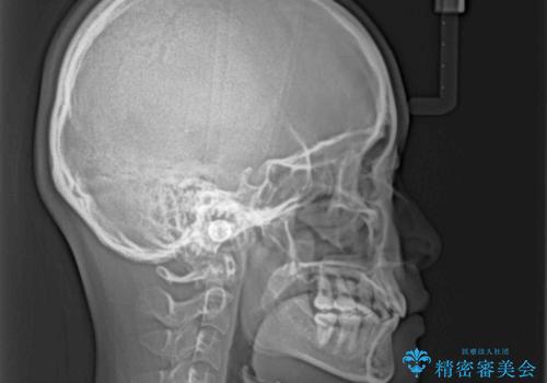 飛び出した上顎前歯 ワイヤー装置にて抜歯矯正治療の治療後
