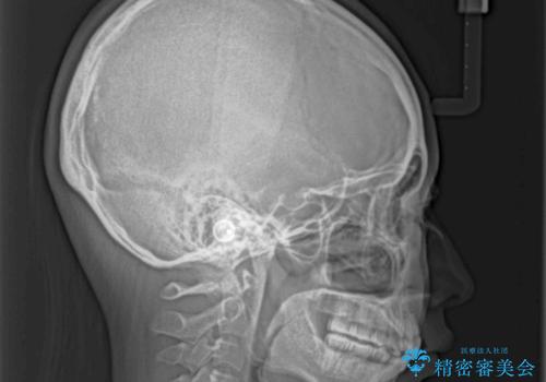 飛び出した上顎前歯 抜歯矯正でスッキリとした横顔にの治療後