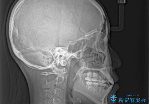 八重歯とオープンバイト 急速拡大装置を用いた矯正治療の治療後
