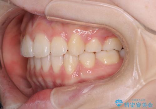 【ワイヤー矯正】オープンバイトを治したいの治療後