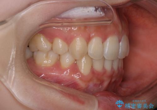 【審美装置】抜歯矯正で口元を改善の治療後