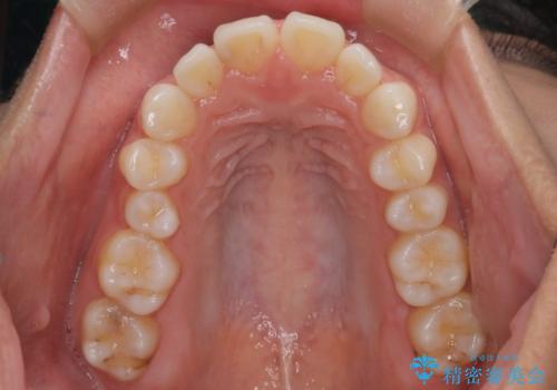 【インビザライン】前歯の後戻りを再矯正の治療前