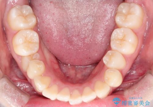 【ワイヤー矯正】オープンバイトを治したいの治療前