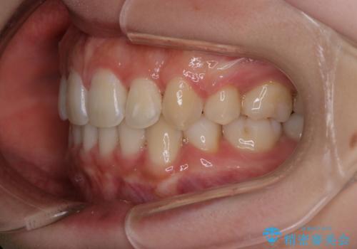 【審美装置】抜歯矯正で口元を改善の治療後