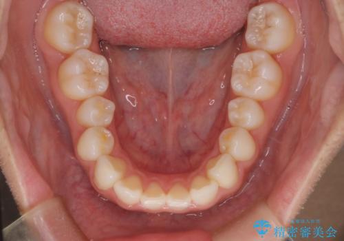 【インビザライン】前歯の後戻りを再矯正の治療前