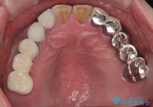 歯肉からの出血 適合の悪い銀歯をオールセラミックのブリッジにやり替えの治療後