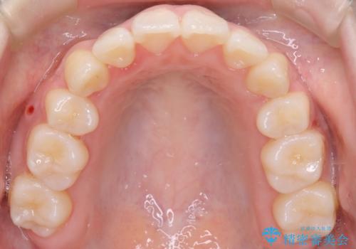 【ワイヤー矯正】オープンバイトを治したいの治療後