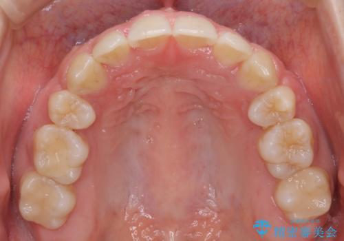 【審美装置】抜歯矯正で口元を改善の治療後