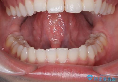 滑舌が気になる、舌小帯形成術の症例 治療後