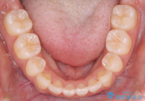 【ワイヤー矯正】オープンバイトを治したいの治療後