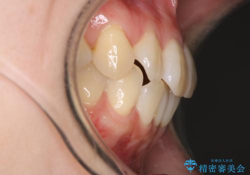 【インビザライン】かみ合わせを整えたいの治療前