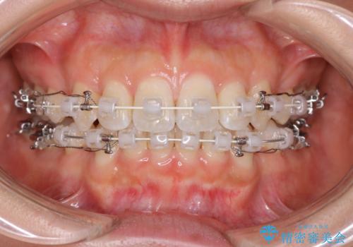 【審美装置】抜歯矯正で口元を改善の治療中