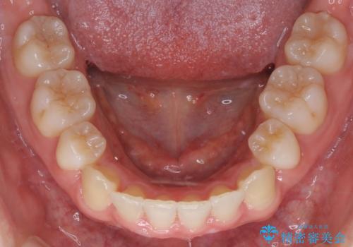 【審美装置】抜歯矯正で口元を改善の治療後