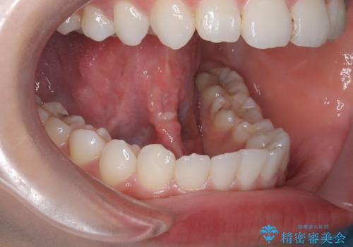 滑舌が気になる、舌小帯形成術の治療後