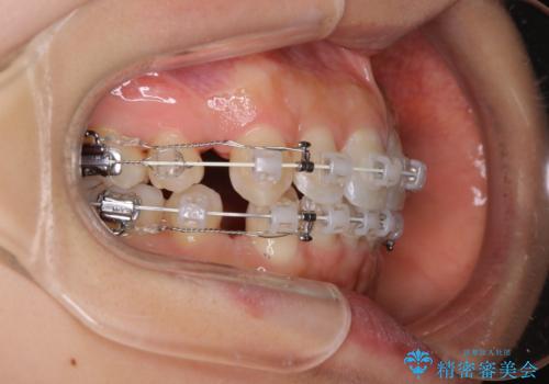 【審美装置】抜歯矯正で口元を改善の治療中