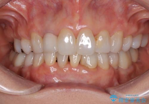 奥歯の目立つ銀歯をセラミックに　オールセラミッククラウン治療の治療後