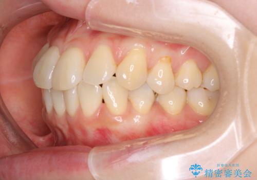 【インビザライン】かみ合わせを整えたいの治療前