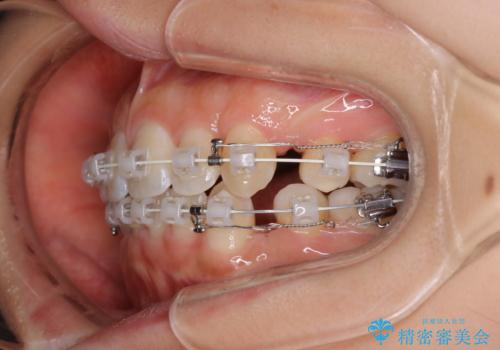 【審美装置】抜歯矯正で口元を改善の治療中