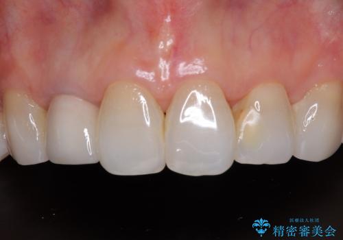 奥歯の目立つ銀歯をセラミックに　オールセラミッククラウン治療の治療後