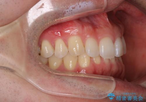 【インビザライン】すきっぱを治したいの治療前