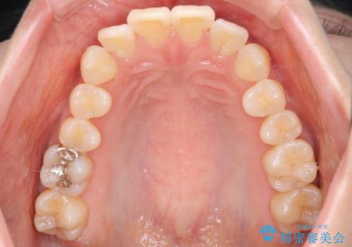 【インビザライン】かみ合わせを整えたいの治療前