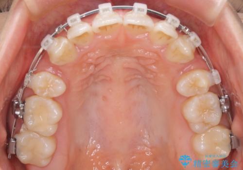 【審美装置】抜歯矯正で口元を改善の治療中