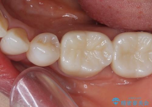 奥歯の目立つ銀歯をセラミックに オールセラミッククラウン治療の治療後