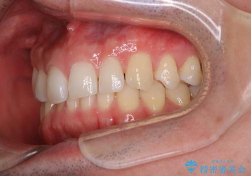 【インビザライン】すきっぱを治したいの治療前
