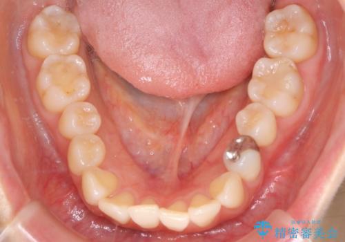 【インビザライン】かみ合わせを整えたいの治療前