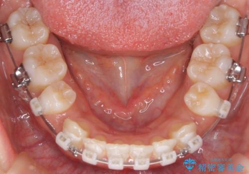 【審美装置】抜歯矯正で口元を改善の治療中