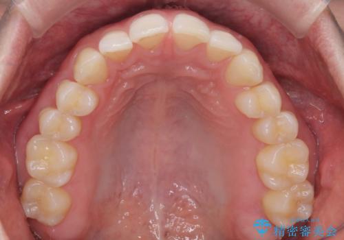 【インビザライン】すきっぱを治したいの治療前