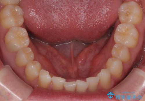 【インビザライン】すきっぱを治したいの治療前