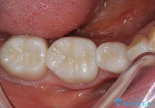 奥歯の目立つ銀歯をセラミックに オールセラミッククラウン治療の治療後