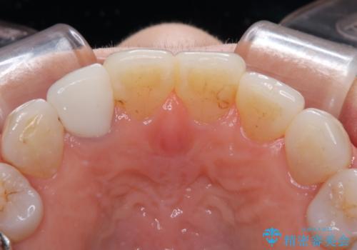 奥歯の目立つ銀歯をセラミックに オールセラミッククラウン治療の治療後