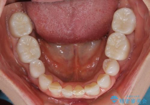 奥歯の目立つ銀歯をセラミックに　オールセラミッククラウン治療の症例 治療後