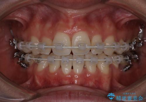 【ワイヤー矯正】口元を歯列矯正で下げたいの治療中