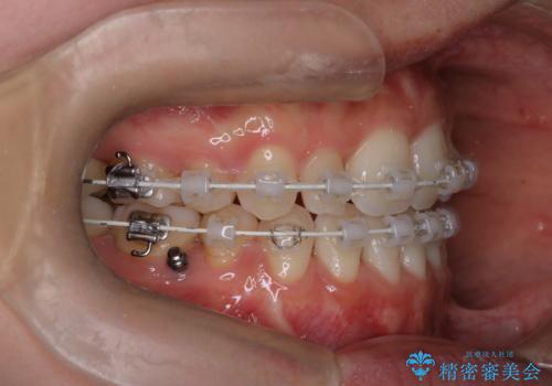 【ワイヤー矯正】口元を歯列矯正で下げたいの治療中