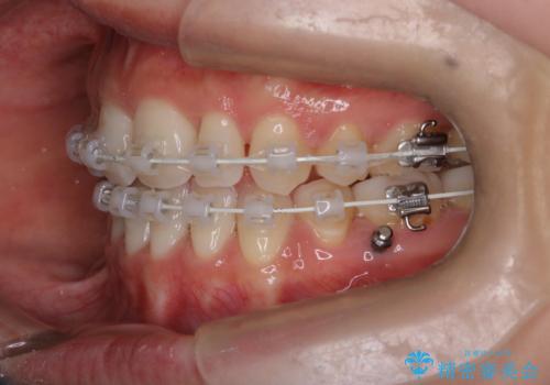 【ワイヤー矯正】口元を歯列矯正で下げたいの治療中