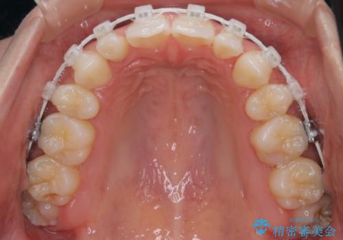 【ワイヤー矯正】口元を歯列矯正で下げたいの治療中