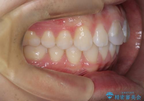 【ワイヤー矯正 11ヵ月で矯正終了!】歯のでこぼこを治したい! の治療後