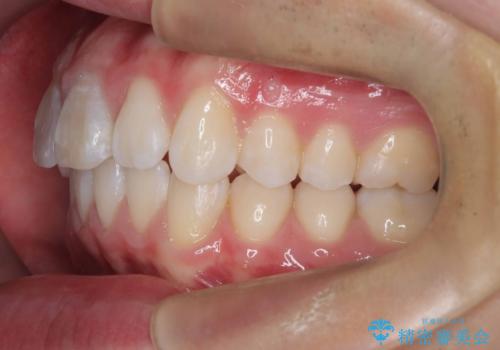 【ワイヤー矯正 11ヵ月で矯正終了!】歯のでこぼこを治したい! の治療後