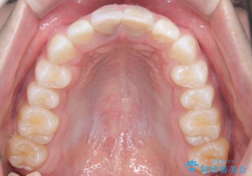 【ワイヤー矯正 11ヵ月で矯正終了!】歯のでこぼこを治したい! の治療後