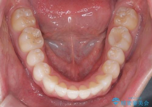 【ワイヤー矯正 11ヵ月で矯正終了!】歯のでこぼこを治したい! の治療後