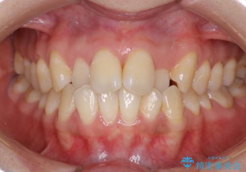 【ワイヤー矯正】前歯のがたつきを短期間で治したいの症例 治療前