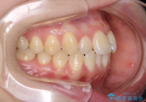【ワイヤー矯正】前歯のがたつきを短期間で治したいの治療前