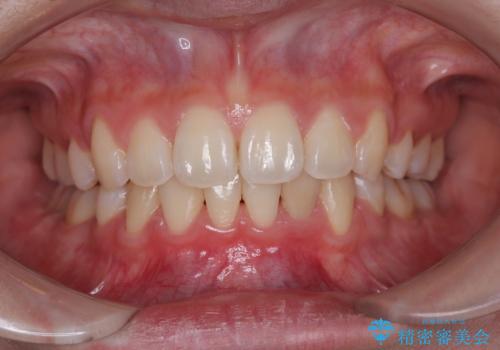 飛び出した上顎前歯 ワイヤー装置にて抜歯矯正治療の症例 治療後