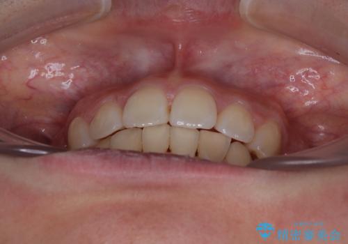 飛び出した上顎前歯 ワイヤー装置にて抜歯矯正治療の治療後