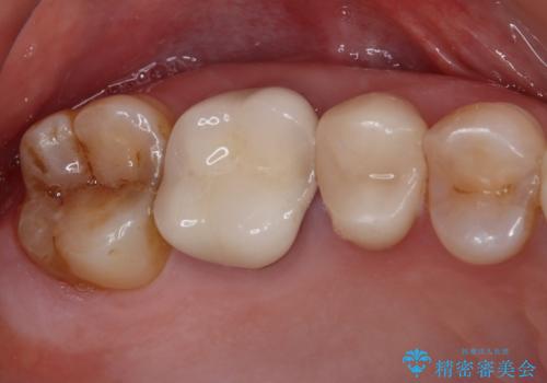 1DAYインプラント 破折して痛みの強い歯 抜歯即時埋入で抜歯した日に仮歯を装着の症例 治療前
